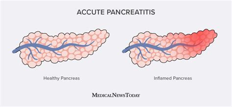 Acute Pancreatitis Symptoms Treatment Causes And Complications
