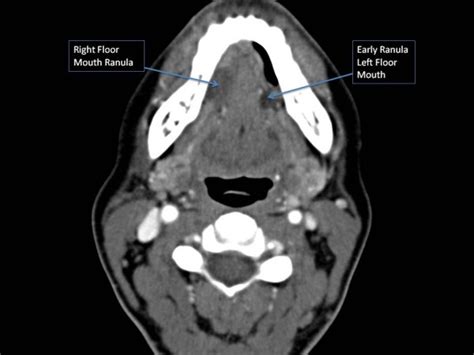 An Axial Contrast Enhanced Ct Image Depicting Bilateral Floor Of Mouth