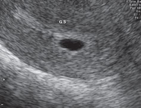 On Showing A Single Intrauterine Gestational Sac Of Mm Download Scientific Diagram
