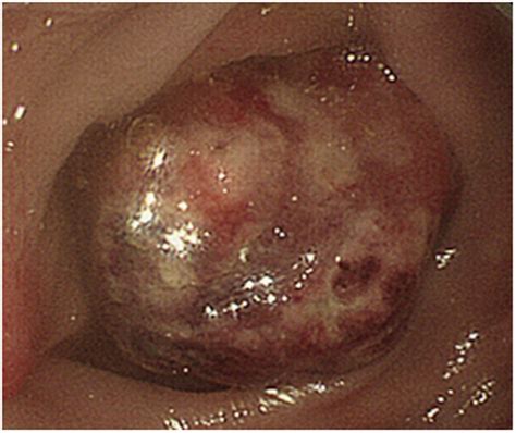 Colonoscopy Shows A Lumen Occupying Protruding Tumor Approximately 3 Cm
