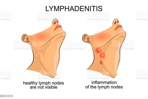 Lymphadenitis Inflammation Of The Lymph Nodes Stock Illustration