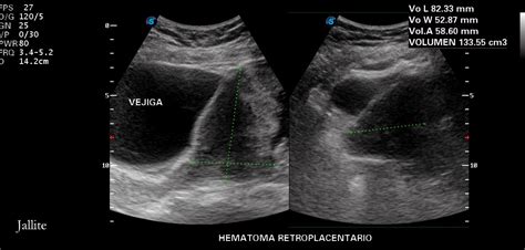 Placenta Previa And Hematoma Retroplacentario