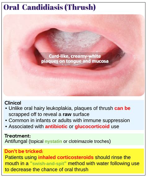 Oral Candidiasis Thrush Medicine Keys For MRCPs