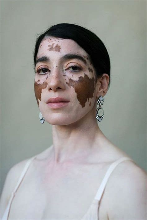 35 Beautiful Women With Vitiligo Shot By A Photographer Who Has The