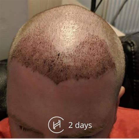 Aggregate Hair Transplant After Days In Eteachers
