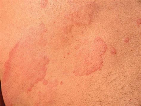 Gallery Of Hives Pictures For Identifying Rashes