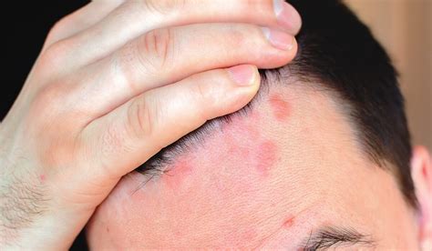 How To Deal With Scalp Sores Life Health Max
