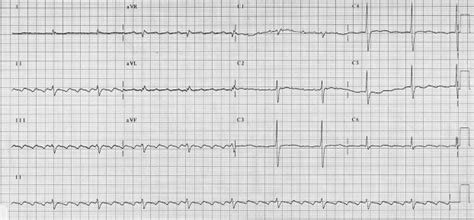 Cardiac Arrhythmias In The Critically Ill Anaesthesia And Intensive