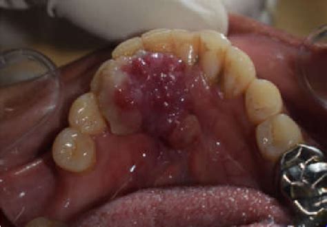 Figure From Lobular Capillary Hemangioma Pyogenic Granuloma With