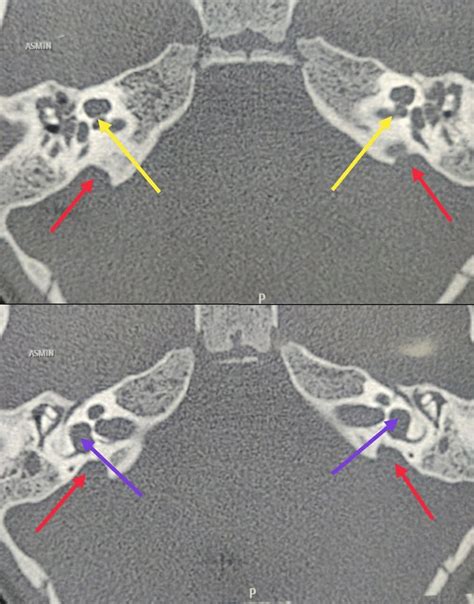 Hrct Temporal Bone Scan Of A Patient With Sms Type Iib Malformation