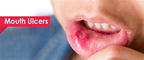 Mouth Oral Ulcers Causes Symptoms Diagnosis Treatment And Prevention