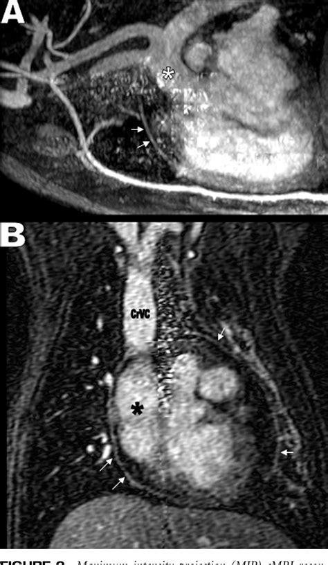 Figure 2 From Cardiac Mri Findings In A Dog With A Diffuse Pericardial