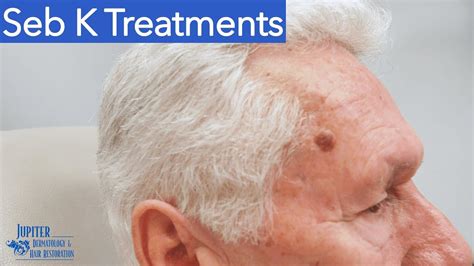 Seborrheic Keratosis Face Treatment Doctor Heck