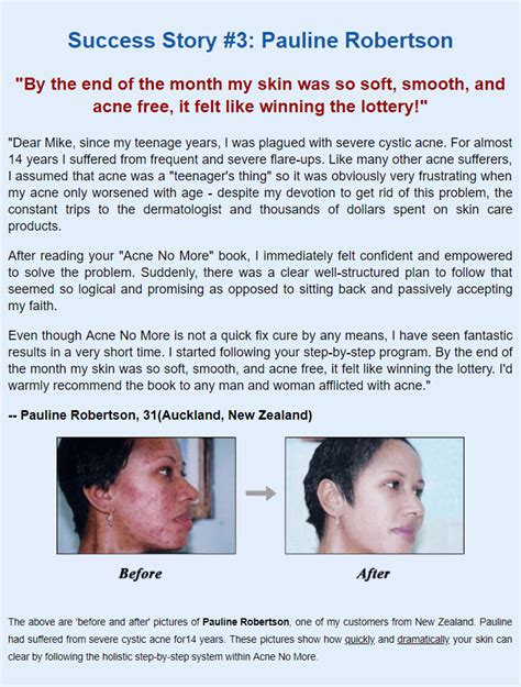 Acne No More Review Getting Rid Of Acne Once And For All In Depth Review