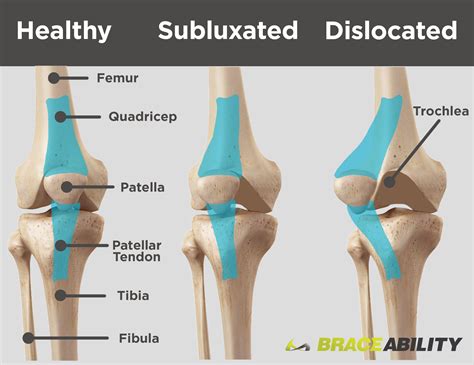 Use This Diagram To See The Difference Between A Subluxated Kneecap And One That Is Fully
