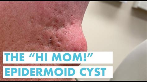 The Hi Mom Epidermoid Cyst Youtube