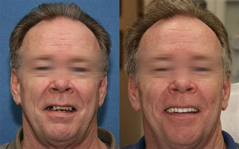 The dental implant procedure is the placement of permanent, prosthetic teeth that look and function like the real thing. Dental Implant Horror Stories | Top Dentist Reviews
