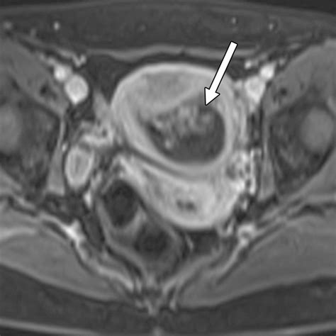 Gestational Trophoblastic Disease Clinical And Imaging Features