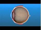 Detached Retina Recovery Face Down Images