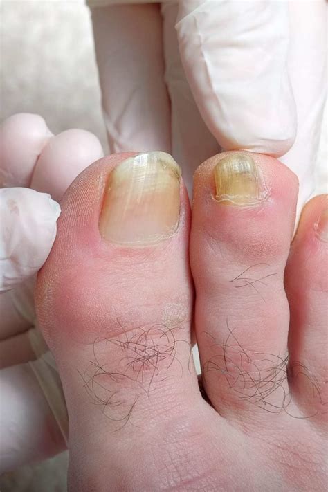 Why Are My Toenails Yellow Causes And Treatment