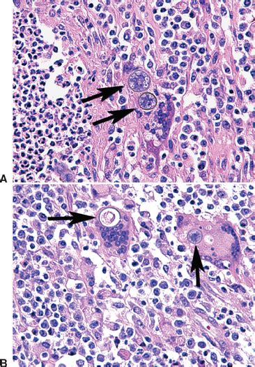 Coccidioidomycosis Veterian Key