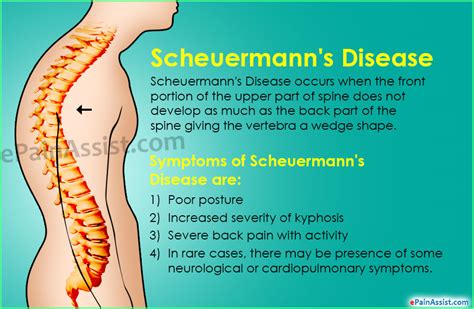 Scheuermanns Disease Or Scheuermanns Kyphosiscausessymptoms