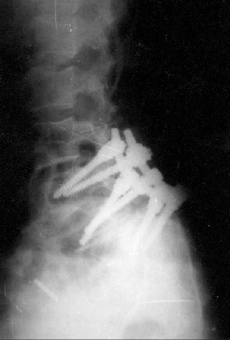 Postoperative Lateral Lumbosacral Radiograph Of The Patient Download