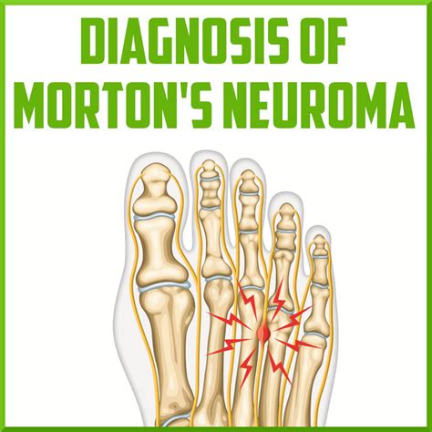 Diagnosis Of A Mortons Neuroma Sports Medicine Review