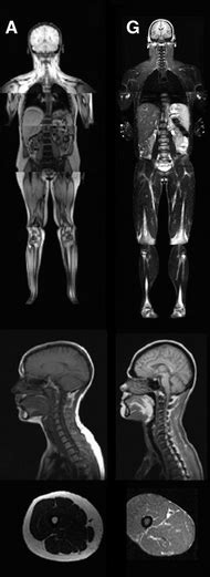 Renaissance of a syndrome // clin endocrinol (oxf). Congenital generalized lipodystrophy - Wikipedia