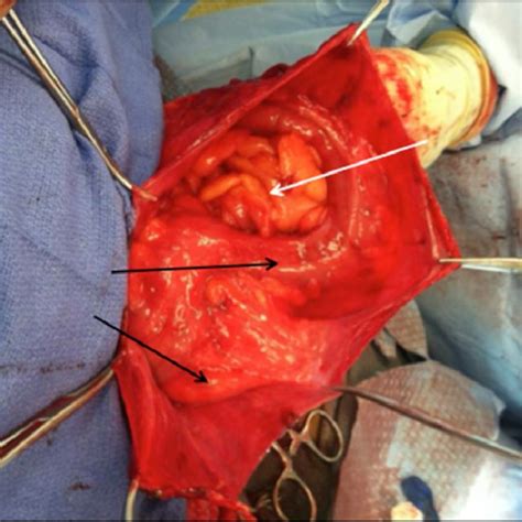 A The Left Inguinal Hernia Sac Is Opened Revealing A Sliding Sigmoid