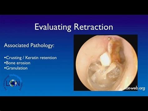 The 18th Otology Course Lecture Tympanic Membrane Retraction Neil