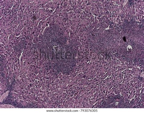 Human Pathology Foreign Body Granulome Hemosiderin Stock Photo