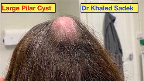 Massive Pilar Cyst Removal Dr Khaled Sadek Pimple