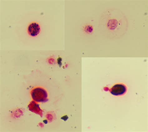 Strange Microorganisms In Csf Gram Stain Of Meningitis Patient Microbiology