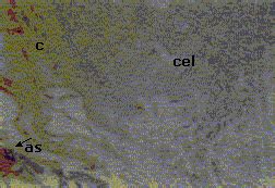90% occur in parotid gland (represent 60% of parotid tumors; Adenoma pleomorfo benigno contralateral en glandulas ...