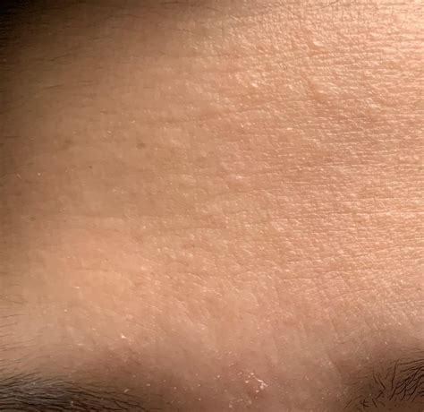 Skin Concern Help Please How Do I Get Rid Of The Bumps And Flakiness