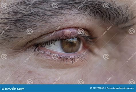 Close Up Stye Hordeolum Chalazion Macro Detail Of An Eye Infection