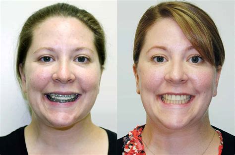 Lower Jaw And Chin Forward Corrective Jaw Surgery Dr Antipov