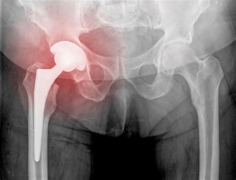 how do you know when you need a hip replacement