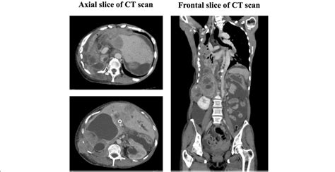 Diagnostic Computed Tomography Ct Image Before The Patients Death