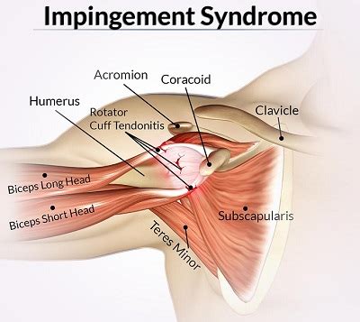 An effective nonoperative treatment for impingement syndrome is aimed at addressing the underlying causative factor or factors that are identified after a. What Is and How to Treat Rotator Cuff Impingement? | New ...