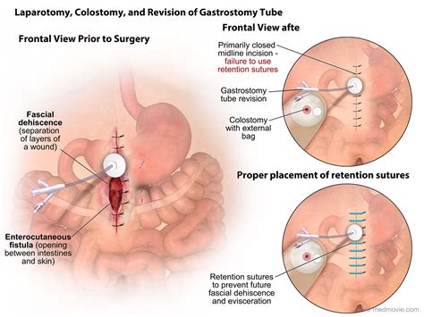 Medmovie Com Laparotomy Colostomy And Revision Of Gastrotomy Tube