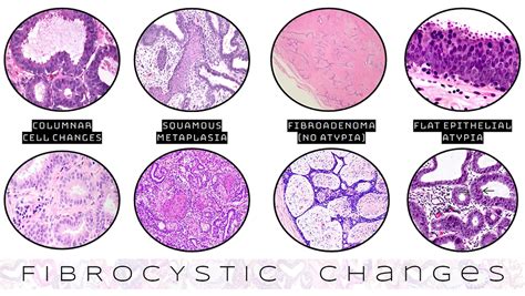High Yield Breast Pathology Fibrocystic Changes
