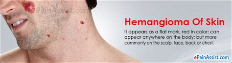 Hemangioma Of Skin Treatment Causes Symptoms Signs