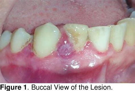 Figure From Nonsurgical Management Of Rapidly Recurrent Gingival