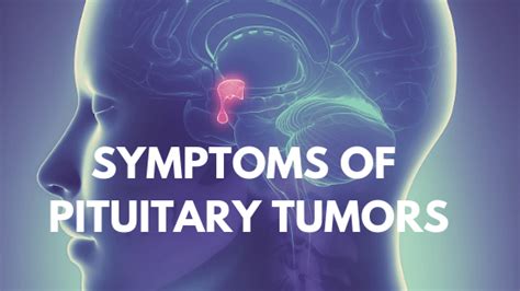 Symptoms Of Pituitary Tumors In 2020 Tumor Symptoms Pituitary Gland