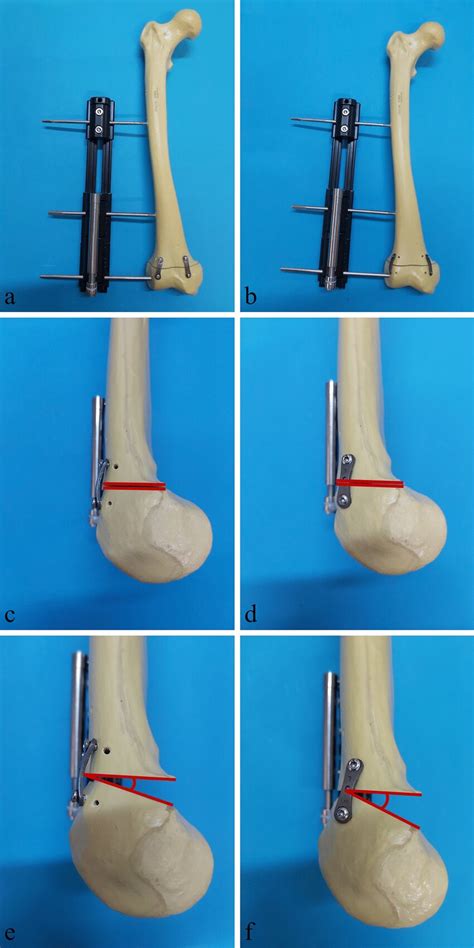 Anteroposterior View Of The Growth Model With Plates Fixed At The