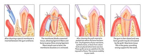 Guided Tissue Regenration In Birmingham Al Periodontist In