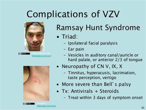 Ramsay Hunt Syndrome Causes Symptoms Body Disorders Facial
