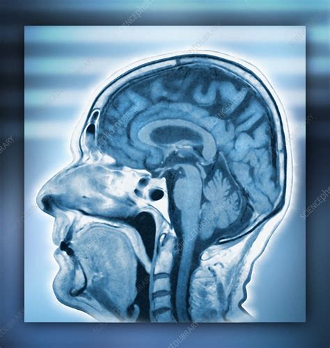 Normal Head And Brain Mri Scan Stock Image F0012974 Science